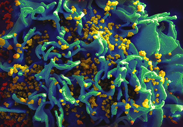 Mit dem Elektronenmikrokop gelingen nur Momentaufnahmen der Virenreifung, hier HI-Viruspartikel auf einer T-Zelle.