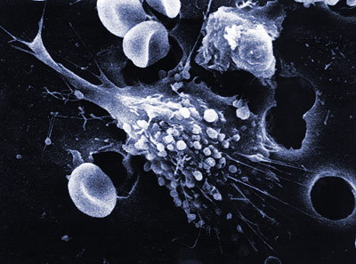 Mobile Krebszellen wandern im KÖrper umher und erzeugen Metastasen.