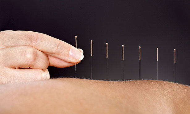 Akupunktur lindert Schmerzen bei der Fibromyalgie
