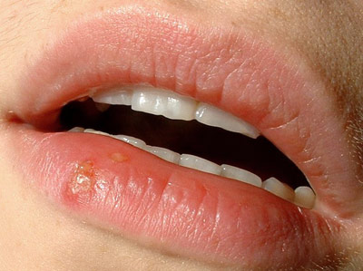 Herpesbläschen an der Lippe