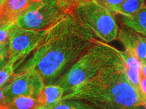 Zellen auf Wanderschaft: Mit Hilfe von Mikrotubuli (grün) und Aktin-Myosin-Fasern (rot) können sich diese Brustkrebszellen bewegen.