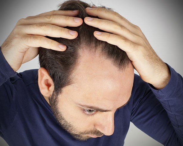 Glatze Bei Kleinen Mannern Haufiger Genstudie Findet Verbindungen Zwischen Haarausfall Und Korpermerkmalen Scinexx De