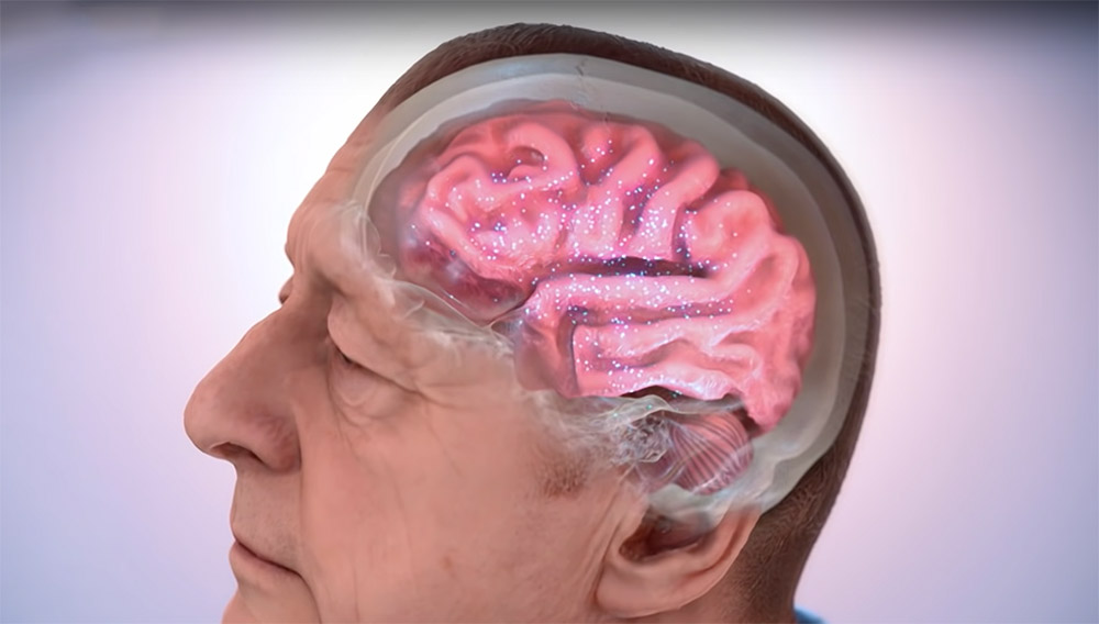 Se han identificado cinco subtipos de la enfermedad de Alzheimer: las variantes de la demencia se diferencian por las proteínas del líquido cefalorraquídeo y, por supuesto, por las causas moleculares.