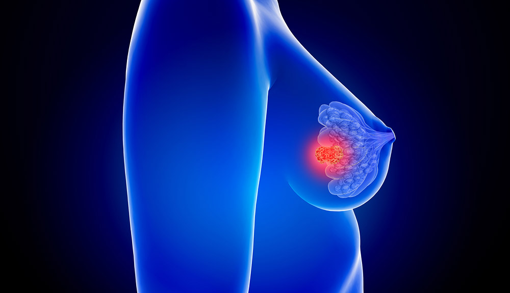 Dove inizia il cancro al seno geneticamente determinato – I ricercatori identificano le cellule di origine del cancro al seno BRCA2 e il potenziale trattamento