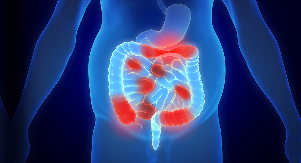 Tien nieuwe risicogenen voor de ziekte van Crohn geïdentificeerd – genvarianten bieden nieuwe aanknopingspunten tegen IBD