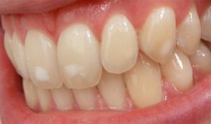 Zahnfluorose