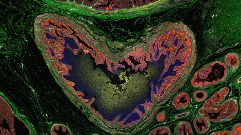 Herzförmiger Tumorquerschnitt