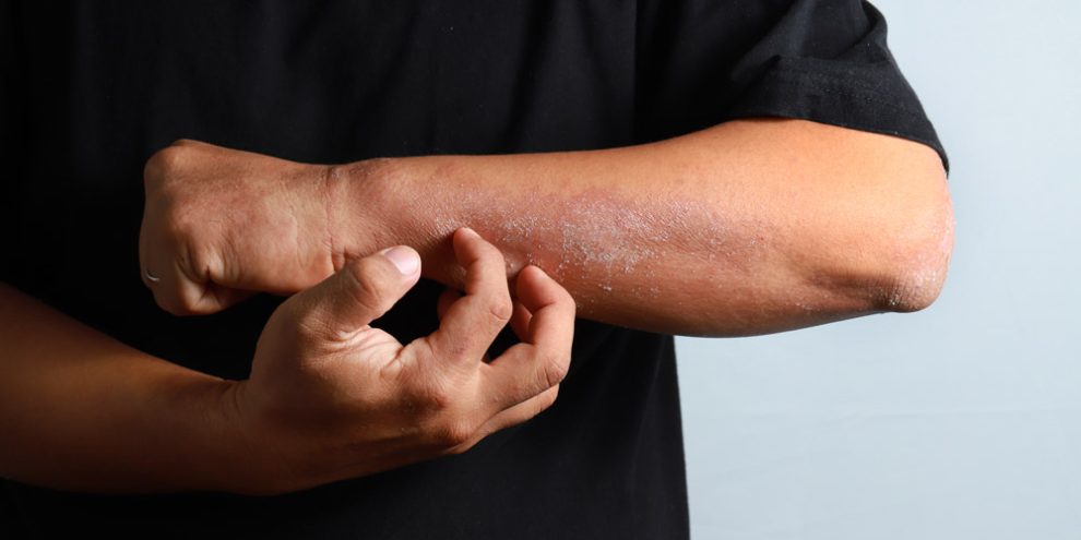 Eine Person kratzt sich am Arm, wo die Haut einen Ausschlag aufweist