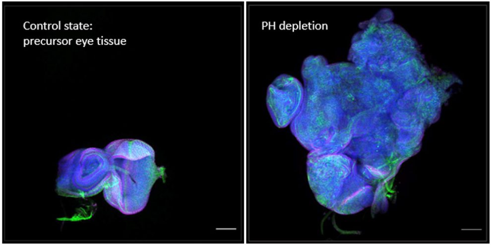 Mikroskopaufnahme eines angefärbten Tumors, der durch einen epigenetischen Schalter entstanden ist