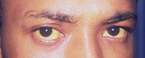 Gelb gefärbte Augen und Haut eines Mannes mit Gelbsucht