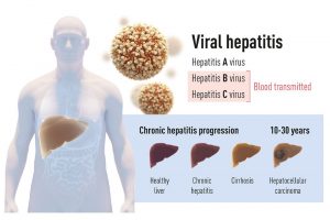 Hepatitis