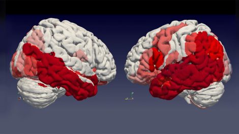 Parkinson-Gehirn
