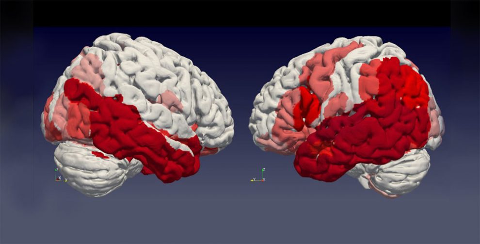 Parkinson-Gehirn