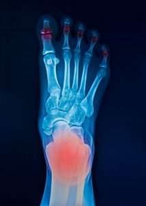 Röntgenbild von einem Fuß