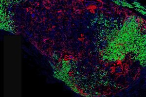 Aufnahme eines Fluoreszenzmikroskops: Angefärbte Wirbelknochenzellen (rot) und Brustkrebstumorzellen (grün).