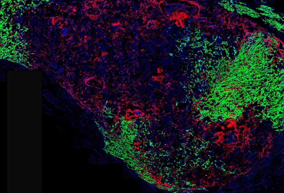 Aufnahme eines Fluoreszenzmikroskops: Angefärbte Wirbelknochenzellen (rot) und Brustkrebstumorzellen (grün).